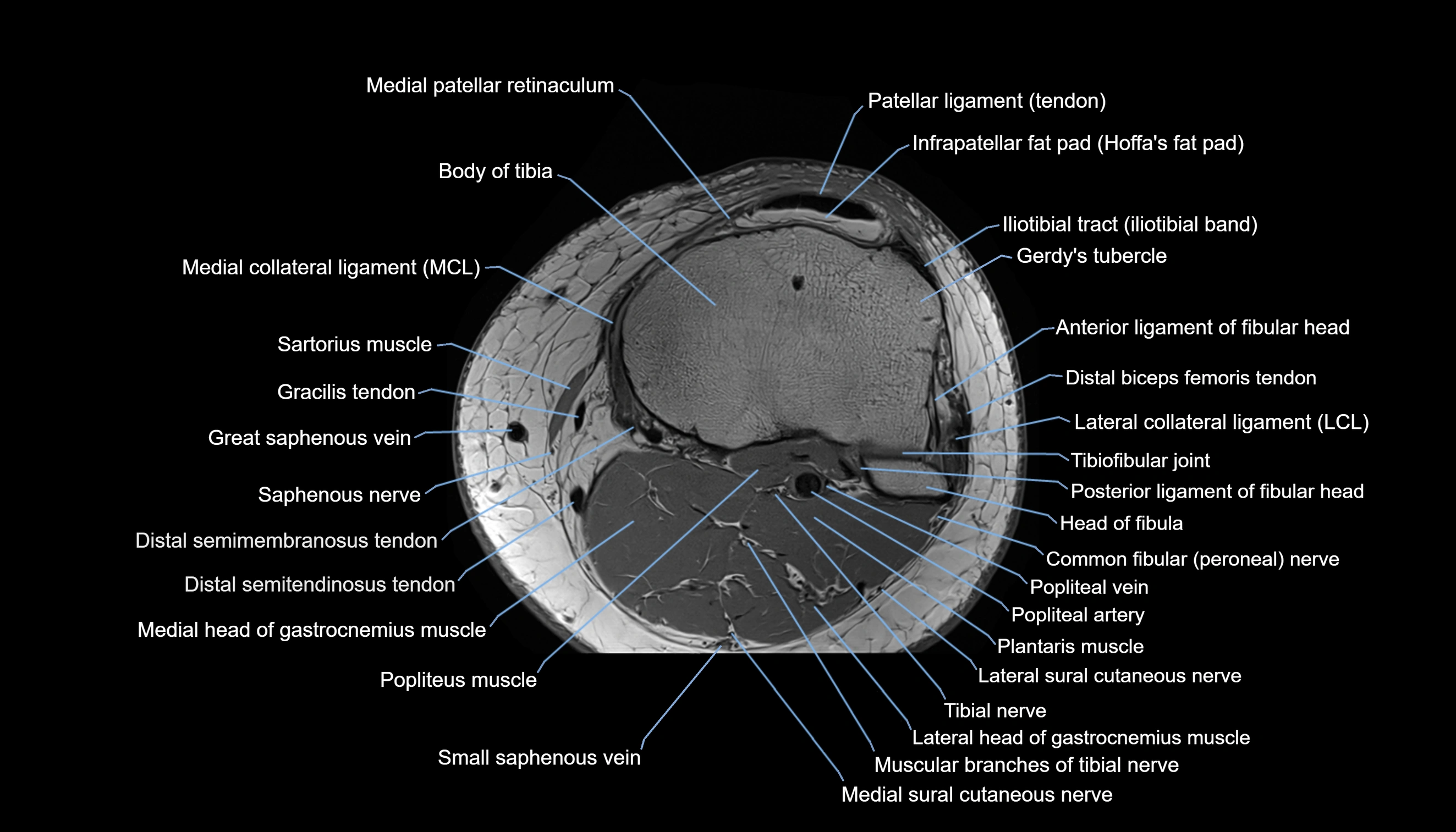 MRI knee  axial cross sectional anatomy 3T radiology  image-img-00001-00038.webp